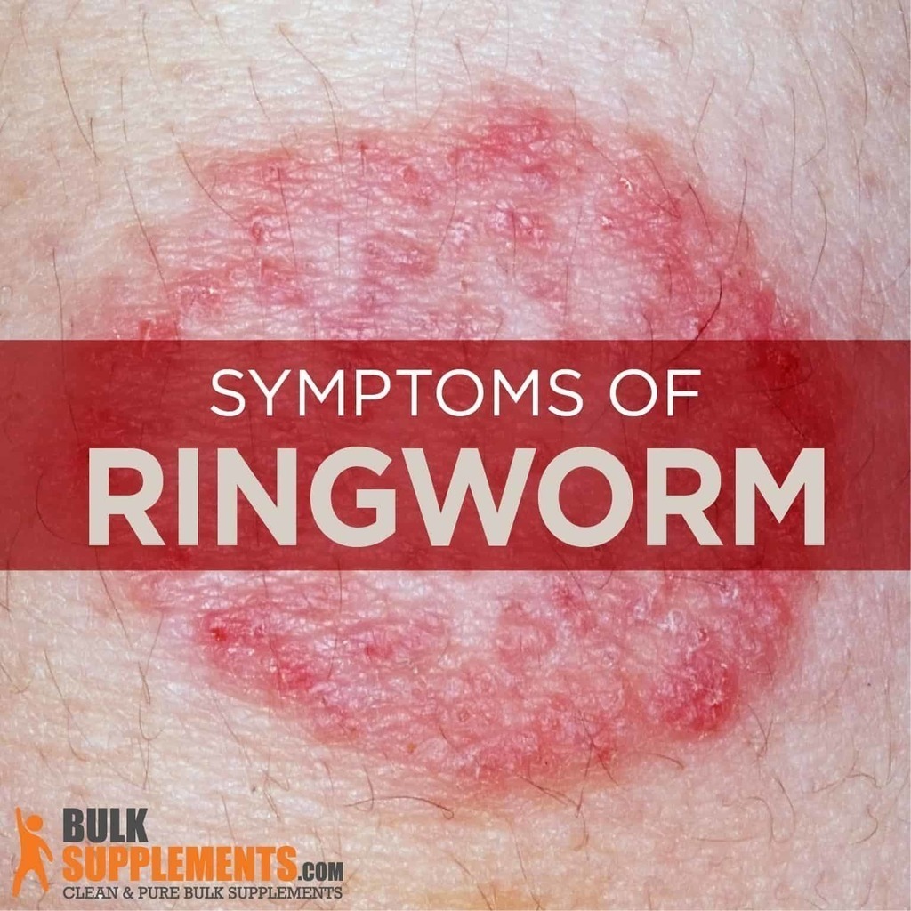 Tablo Read 'Ringworm Symptoms, Causes & Treatment' by