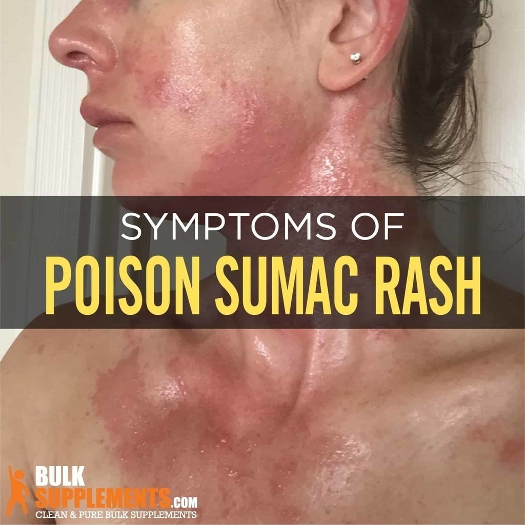 Tablo Read 'Poison Sumac Rash Characteristics, Causes & Treatment' by